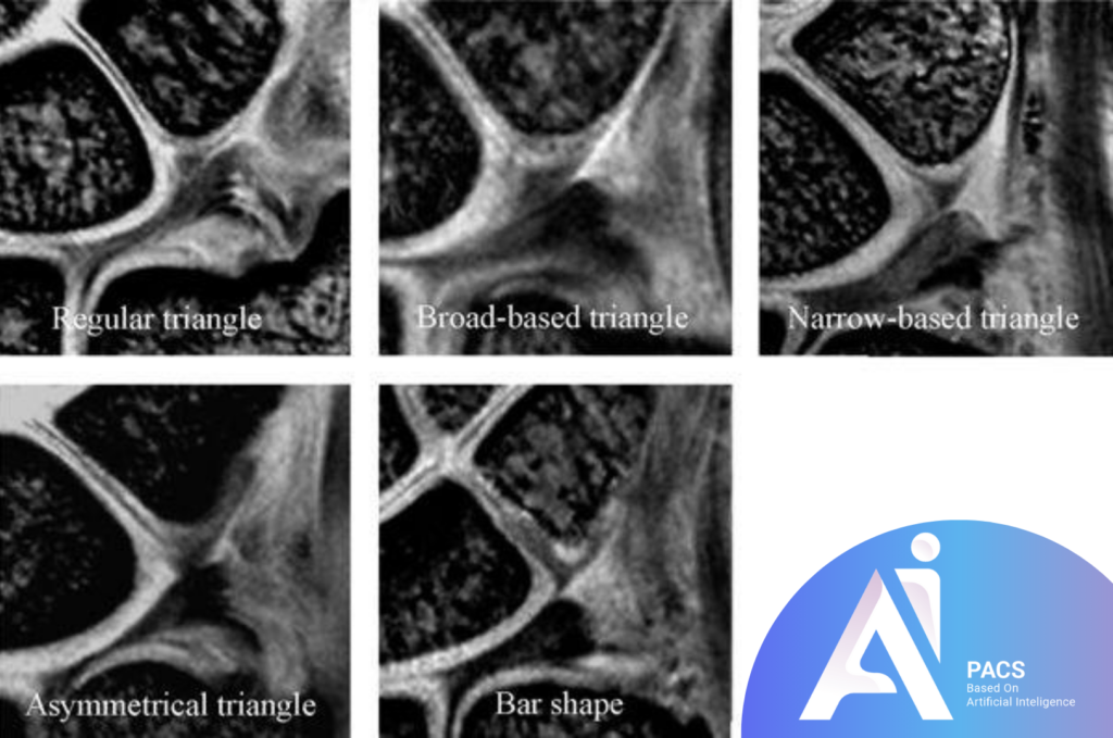 what is TFCC in MRI